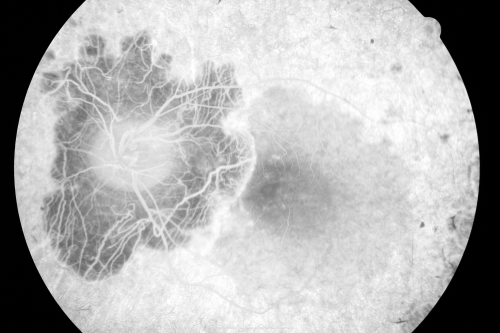 Acute Zonal Occult Outer Retinopathy with Severe Peripheral Vision Loss Left Eye 
 58-year-old man developed a peripheral vision problem about 25 years ago.   OD 20/30, OS 20/40.
Schlüsselwörter: azoor;bone spicules;retinitis pigmentosa;rp;pseudo
