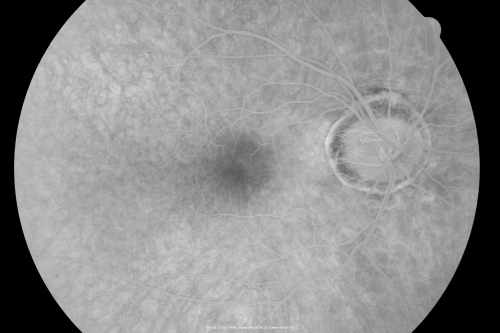Acute Zonal Occult Outer Retinopathy with Severe Peripheral Vision Loss Left Eye 
 58-year-old man developed a peripheral vision problem about 25 years ago.   OD 20/30, OS 20/40.
Keywords: azoor;bone spicules;retinitis pigmentosa;rp;pseudo