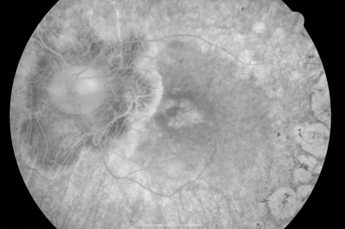 Acute Zonal Occult Outer Retinopathy with Severe Peripheral Vision Loss Left Eye 
 58-year-old man developed a peripheral vision problem about 25 years ago.   OD 20/30, OS 20/40.
Keywords: azoor;bone spicules;retinitis pigmentosa;rp;pseudo