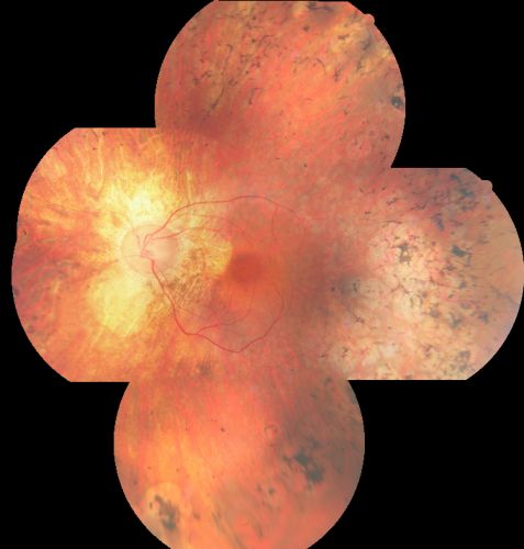 Acute Zonal Occult Outer Retinopathy with Severe Peripheral Vision Loss Left Eye 
 58-year-old man developed a peripheral vision problem about 25 years ago.   OD 20/30, OS 20/40.
Mots-clés: azoor;bone spicules;retinitis pigmentosa;rp;pseudo