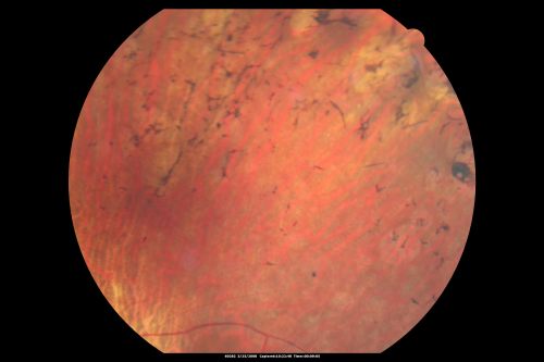 Acute Zonal Occult Outer Retinopathy with Severe Peripheral Vision Loss Left Eye 
 58-year-old man developed a peripheral vision problem about 25 years ago.   OD 20/30, OS 20/40.
Keywords: azoor;bone spicules;retinitis pigmentosa;rp;pseudo