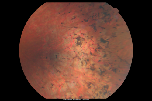 Acute Zonal Occult Outer Retinopathy with Severe Peripheral Vision Loss Left Eye 
 58-year-old man developed a peripheral vision problem about 25 years ago.   OD 20/30, OS 20/40.
Keywords: azoor;bone spicules;retinitis pigmentosa;rp;pseudo