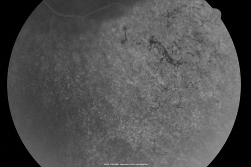Acute Zonal Occult Outer Retinopathy
45-year-old man  noticed a few years ago peripheral vision blurriness in the left eye and also some central vision loss.   Previous to that, as far as he knows, the two eyes were okay. 

VISUAL ACUITY:  OD:  20/20;  OS:  20/40.  
Schlüsselwörter: azoor;acute zonal occult outer retinopathy;retinitis pigmentosa