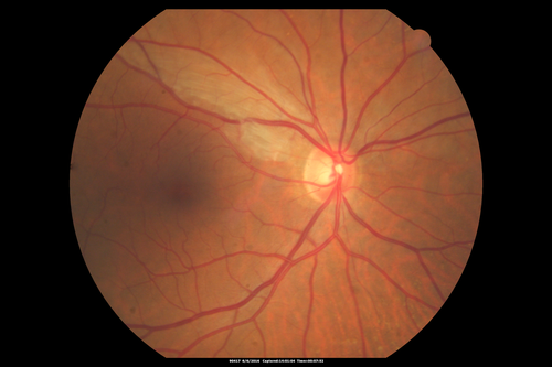 Bilateral Branch Retinal Artery Occlusion - Intraarterial (hollenhorst) plaques visible
67 year old with acute visual field loss in each eye.  Vision is 20/25 right eye 20/32 left eye.  Images show intra-arterial plaques in each eye.  The right eye on the optic nerve and the left eye in a branch retinal artery.
