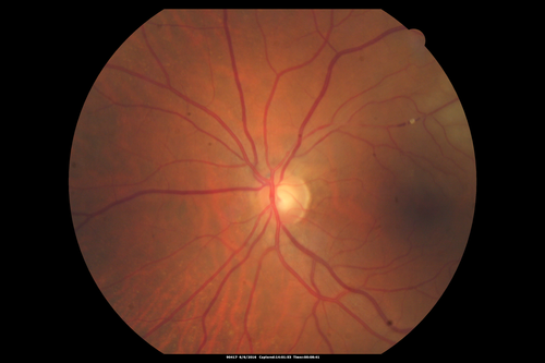 Bilateral Branch Retinal Artery Occlusion - Intraarterial (hollenhorst) plaques visible
67 year old with acute visual field loss in each eye.  Vision is 20/25 right eye 20/32 left eye.  Images show intra-arterial plaques in each eye.  The right eye on the optic nerve and the left eye in a branch retinal artery.
