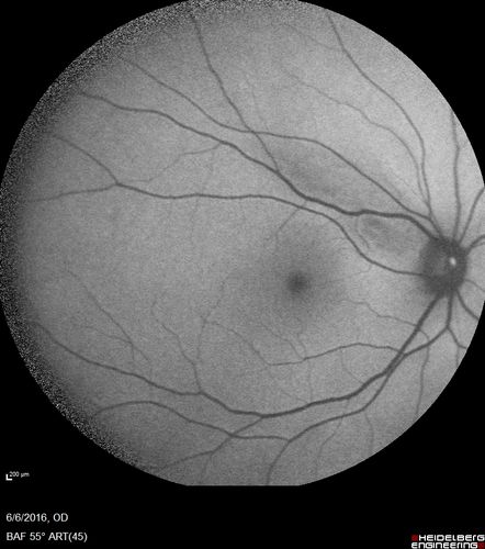 Bilateral Branch Retinal Artery Occlusion - Intraarterial (hollenhorst) plaques visible
67 year old with acute visual field loss in each eye.  Vision is 20/25 right eye 20/32 left eye.  Images show intra-arterial plaques in each eye.  The right eye on the optic nerve and the left eye in a branch retinal artery.
