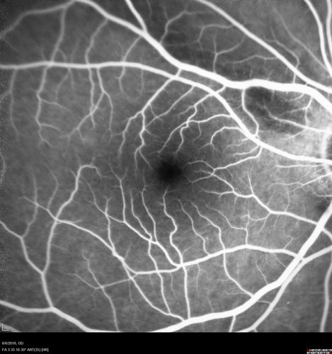 Bilateral Branch Retinal Artery Occlusion - Intraarterial (hollenhorst) plaques visible
67 year old with acute visual field loss in each eye.  Vision is 20/25 right eye 20/32 left eye.  Images show intra-arterial plaques in each eye.  The right eye on the optic nerve and the left eye in a branch retinal artery.
