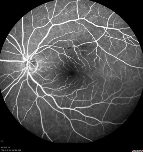 Bilateral Branch Retinal Artery Occlusion - Intraarterial (hollenhorst) plaques visible
67 year old with acute visual field loss in each eye.  Vision is 20/25 right eye 20/32 left eye.  Images show intra-arterial plaques in each eye.  The right eye on the optic nerve and the left eye in a branch retinal artery.
