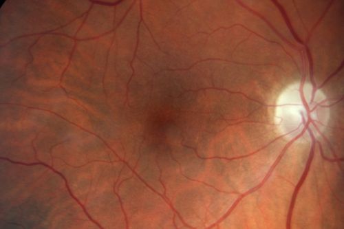 Sectoral Optic Atrophy from an old Branch Retinal Artery Occlusion 
74-year-old woman had cataract surgery 3 months ago.  Her vision in the right eye has been abnormal since.  She notices a shadow in the inferior vision in the right eye.    OD is 20/60, OS is 20/50

