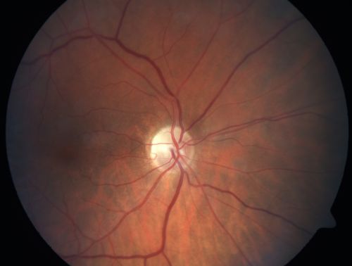 Sectoral Optic Atrophy from an old Branch Retinal Artery Occlusion 
74-year-old woman had cataract surgery 3 months ago.  Her vision in the right eye has been abnormal since.  She notices a shadow in the inferior vision in the right eye.    OD is 20/60, OS is 20/50
