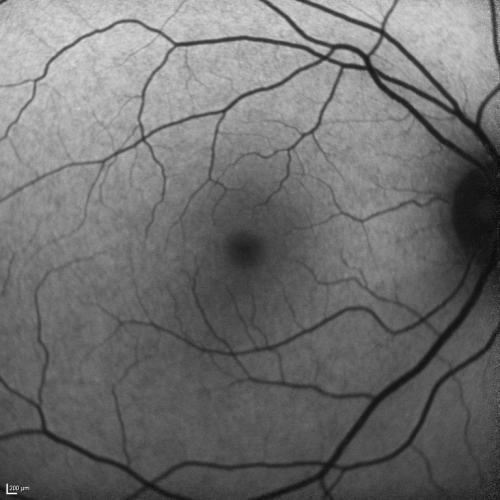 Basal Laminar Drusen - Cuticular Drusen - 19 Year Old with Lupus Nephritis
19-year-old.  She has a history of developing severe systemic lupus erythematosus in 2001.  She was in renal failure and had biopsy proven Class 2 lupus nephritis.  She is currently on Plaquenil 400 mg for six years, as well as Prednisolone orally, every other day. OD 20/20, OS 20/25.
