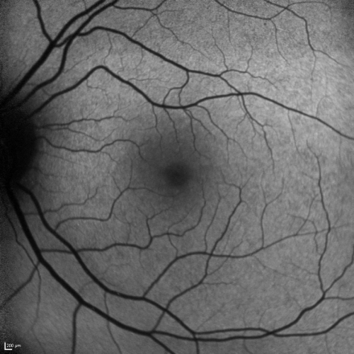 Basal Laminar Drusen - Cuticular Drusen - 19 Year Old with Lupus Nephritis
19-year-old.  She has a history of developing severe systemic lupus erythematosus in 2001.  She was in renal failure and had biopsy proven Class 2 lupus nephritis.  She is currently on Plaquenil 400 mg for six years, as well as Prednisolone orally, every other day. OD 20/20, OS 20/25.
