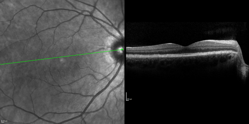 Basal Laminar Drusen - Cuticular Drusen - 19 Year Old with Lupus Nephritis
19-year-old.  She has a history of developing severe systemic lupus erythematosus in 2001.  She was in renal failure and had biopsy proven Class 2 lupus nephritis.  She is currently on Plaquenil 400 mg for six years, as well as Prednisolone orally, every other day. OD 20/20, OS 20/25.
