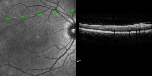 Basal Laminar Drusen - Cuticular Drusen - 19 Year Old with Lupus Nephritis
19-year-old.  She has a history of developing severe systemic lupus erythematosus in 2001.  She was in renal failure and had biopsy proven Class 2 lupus nephritis.  She is currently on Plaquenil 400 mg for six years, as well as Prednisolone orally, every other day. OD 20/20, OS 20/25.
