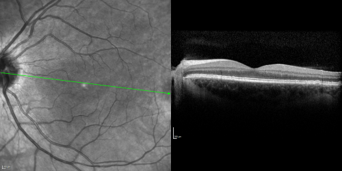 Basal Laminar Drusen - Cuticular Drusen - 19 Year Old with Lupus Nephritis
19-year-old.  She has a history of developing severe systemic lupus erythematosus in 2001.  She was in renal failure and had biopsy proven Class 2 lupus nephritis.  She is currently on Plaquenil 400 mg for six years, as well as Prednisolone orally, every other day. OD 20/20, OS 20/25.
