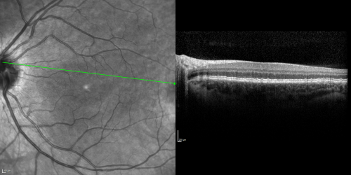 Basal Laminar Drusen - Cuticular Drusen - 19 Year Old with Lupus Nephritis
19-year-old.  She has a history of developing severe systemic lupus erythematosus in 2001.  She was in renal failure and had biopsy proven Class 2 lupus nephritis.  She is currently on Plaquenil 400 mg for six years, as well as Prednisolone orally, every other day. OD 20/20, OS 20/25.
