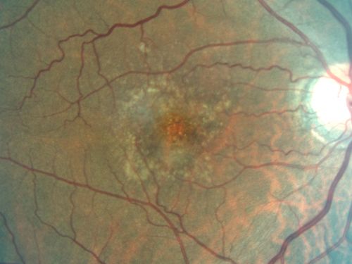 Basal Laminar (cuticular) Drusen both eyes 60 Year Old Woman
60-year-old woman with minimal vision loss.  Vision OD is 20/30 OS 20/40
