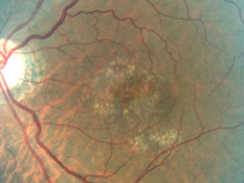 Basal Laminar (cuticular) Drusen both eyes 60 Year Old Woman
60-year-old woman with minimal vision loss.  Vision OD is 20/30 OS 20/40

