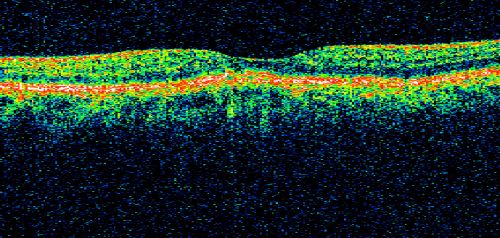 Basal Laminar (cuticular) Drusen both eyes 60 Year Old Woman
60-year-old woman with minimal vision loss.  Vision OD is 20/30 OS 20/40
