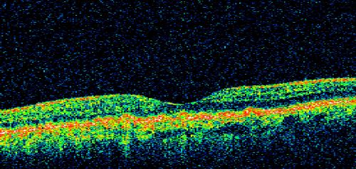 Basal Laminar (cuticular) Drusen both eyes 60 Year Old Woman
60-year-old woman with minimal vision loss.  Vision OD is 20/30 OS 20/40
