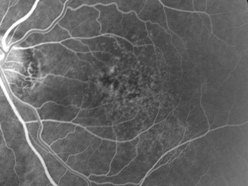 Basal Laminar (cuticular) Drusen both eyes 60 Year Old Woman
60-year-old woman with minimal vision loss.  Vision OD is 20/30 OS 20/40
