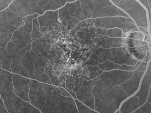 Basal Laminar (cuticular) Drusen both eyes 60 Year Old Woman
60-year-old woman with minimal vision loss.  Vision OD is 20/30 OS 20/40
