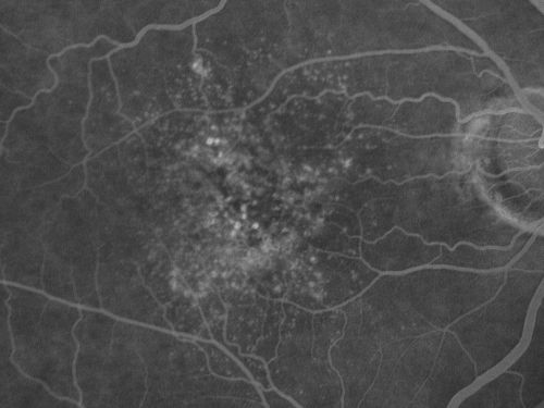 Basal Laminar (cuticular) Drusen both eyes 60 Year Old Woman
60-year-old woman with minimal vision loss.  Vision OD is 20/30 OS 20/40
