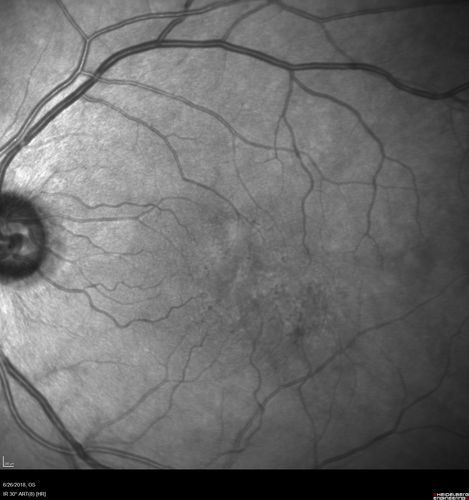 Diabetic Macular Ischemia - Enlarged FAZ - OCT-A
70 year old female diagnosed with diabetes 2 years ago.  Her blood pressure was normal at 116/73.  She has vision loss for 6 months in both eyes.  VA is 20/100 OU.  OCT-A shows macular ischemia.
