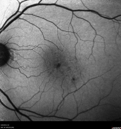 Diabetic Macular Ischemia - Enlarged FAZ - OCT-A
70 year old female diagnosed with diabetes 2 years ago.  Her blood pressure was normal at 116/73.  She has vision loss for 6 months in both eyes.  VA is 20/100 OU.  OCT-A shows macular ischemia.
