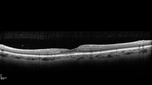 Diabetic Macular Ischemia - Enlarged FAZ - OCT-A
70 year old female diagnosed with diabetes 2 years ago.  Her blood pressure was normal at 116/73.  She has vision loss for 6 months in both eyes.  VA is 20/100 OU.  OCT-A shows macular ischemia.
