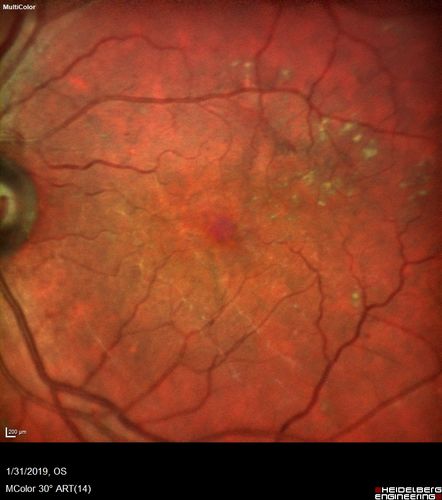 bdr_edema_laser_redas_013119_02.jpg