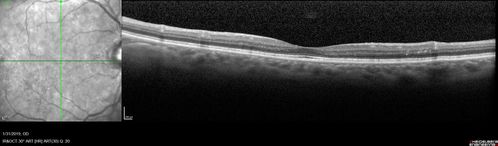 bdr_edema_laser_redas_013119_03.jpg