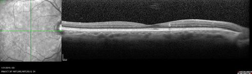 bdr_edema_laser_redas_013119_04.jpg