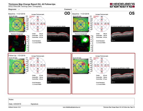 bdr_edema_laser_redas_013119_07.JPG