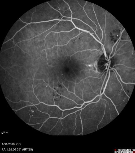 bdr_edema_laser_redas_013119_09.jpg