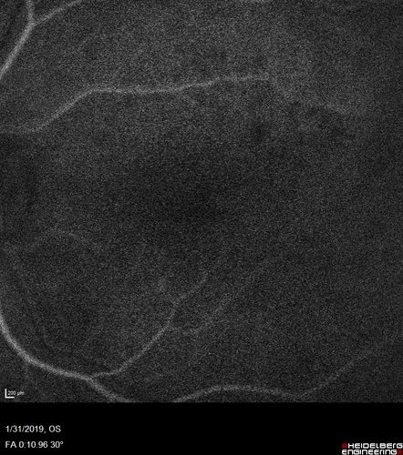 bdr_edema_laser_redas_013119_11.jpg