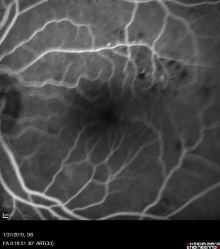 bdr_edema_laser_redas_013119_12.jpg