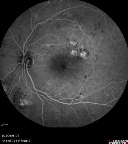 bdr_edema_laser_redas_013119_16.jpg