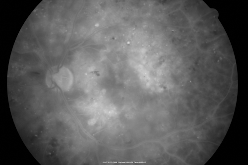 Diabetic and Pseudophakic Cystoid Macular Edema Late FA
56-year-old woman has diabetic retinopathy in both eyes and macular edema.  She is recently pseudophakic.  OD 20/80, OS 20/200.  
Keywords: cme;bdr;pseudophakic;laser;kenalog
