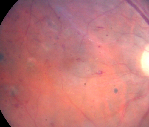 Diabetic and Pseudophakic Cystoid Macular Edema Pretreatment Fundus Photo
56-year-old woman has diabetic retinopathy in both eyes and macular edema.  She is recently pseudophakic.  OD 20/80, OS 20/200.  
Keywords: cme;bdr;pseudophakic;laser;kenalog