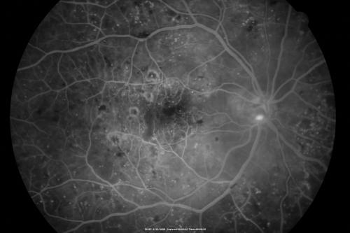 Diabetic and Pseudophakic Cystoid Macular Edema Pretreatment Early FA
56-year-old woman has diabetic retinopathy in both eyes and macular edema.  She is recently pseudophakic.  OD 20/80, OS 20/200.  
Keywords: cme;bdr;pseudophakic;laser;kenalog
