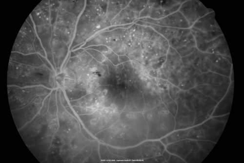 Diabetic and Pseudophakic Cystoid Macular Edema FA Fellow Eye
56-year-old woman has diabetic retinopathy in both eyes and macular edema.  She is recently pseudophakic.  OD 20/80, OS 20/200.  
Keywords: cme;bdr;pseudophakic;laser;kenalog