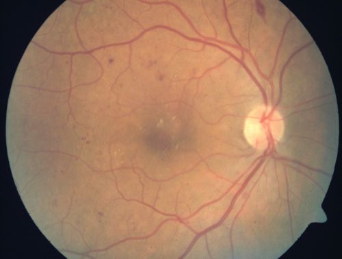 Mild Clinically Significant Diabetic Macular Edema
58-year-old woman diabetic for 20 years who has diabetic macular edema in both eyes.  She has had waxing and waning edema in the past and I thought it might improve on its own but it did not.  She notices her vision is still a little hazy.

VISUAL ACUITY: Vision OD is 20/30, OS is 20/25. 

