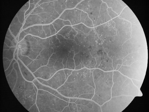 Mild Clinically Significant Diabetic Macular Edema
58-year-old woman diabetic for 20 years who has diabetic macular edema in both eyes.  She has had waxing and waning edema in the past and I thought it might improve on its own but it did not.  She notices her vision is still a little hazy.

VISUAL ACUITY: Vision OD is 20/30, OS is 20/25. 
