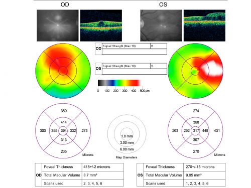 Mild Clinically Significant Diabetic Macular Edema
58-year-old woman diabetic for 20 years who has diabetic macular edema in both eyes.  She has had waxing and waning edema in the past and I thought it might improve on its own but it did not.  She notices her vision is still a little hazy.

VISUAL ACUITY: Vision OD is 20/30, OS is 20/25. 
