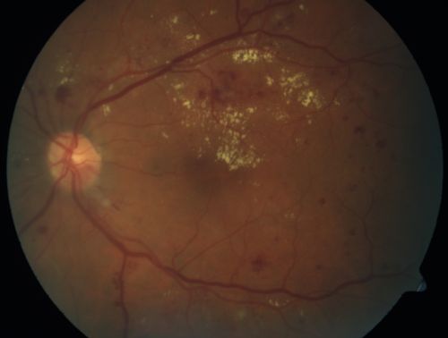 Diabetic Macular Edema and Hypertensive Retinopathy - Circinate Exudate (Ring Exudate) 
55-year-old woman diabetic for fifteen years and  high blood pressure, especially over the last few months.  She has had problems with nosebleeds, headaches, and there has been some difficulty bringing her blood pressure down.  She said now the blood pressure is under control but it was running 220/120 mmHg for some time.  Her vision in the right eye has been poor for four weeks with a spot in the central vision and both eyes have been blurred.

VISUAL ACUITY:  Vision OD is 20/160, OS is 20/60
