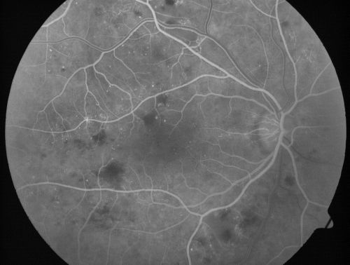 Diabetic Macular Edema and Hypertensive Retinopathy - Circinate Exudate (Ring Exudate) 
55-year-old woman diabetic for fifteen years and  high blood pressure, especially over the last few months.  She has had problems with nosebleeds, headaches, and there has been some difficulty bringing her blood pressure down.  She said now the blood pressure is under control but it was running 220/120 mmHg for some time.  Her vision in the right eye has been poor for four weeks with a spot in the central vision and both eyes have been blurred.

VISUAL ACUITY:  Vision OD is 20/160, OS is 20/60
