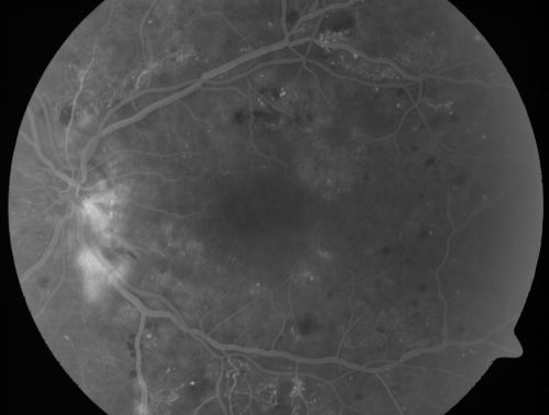 Diabetic Macular Edema and Hypertensive Retinopathy - Circinate Exudate (Ring Exudate) 
55-year-old woman diabetic for fifteen years and  high blood pressure, especially over the last few months.  She has had problems with nosebleeds, headaches, and there has been some difficulty bringing her blood pressure down.  She said now the blood pressure is under control but it was running 220/120 mmHg for some time.  Her vision in the right eye has been poor for four weeks with a spot in the central vision and both eyes have been blurred.

VISUAL ACUITY:  Vision OD is 20/160, OS is 20/60
