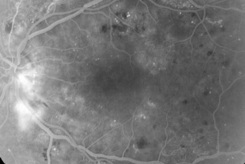 Diabetic Macular Edema and Hypertensive Retinopathy - Circinate Exudate (Ring Exudate) 
55-year-old woman diabetic for fifteen years and  high blood pressure, especially over the last few months.  She has had problems with nosebleeds, headaches, and there has been some difficulty bringing her blood pressure down.  She said now the blood pressure is under control but it was running 220/120 mmHg for some time.  Her vision in the right eye has been poor for four weeks with a spot in the central vision and both eyes have been blurred.

VISUAL ACUITY:  Vision OD is 20/160, OS is 20/60

