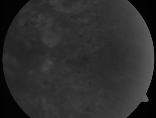 Diabetic Macular Edema and Hypertensive Retinopathy - Circinate Exudate (Ring Exudate) 
55-year-old woman diabetic for fifteen years and  high blood pressure, especially over the last few months.  She has had problems with nosebleeds, headaches, and there has been some difficulty bringing her blood pressure down.  She said now the blood pressure is under control but it was running 220/120 mmHg for some time.  Her vision in the right eye has been poor for four weeks with a spot in the central vision and both eyes have been blurred.

VISUAL ACUITY:  Vision OD is 20/160, OS is 20/60
